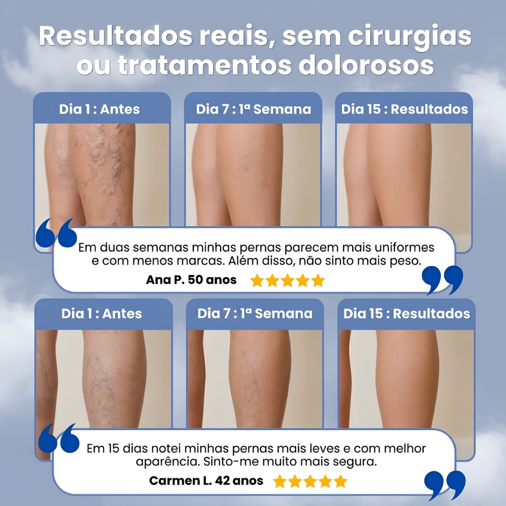 VARIVEINS™ - VOLTA A TER PERNAS LEVES NESTE VERÃO